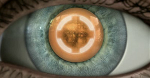 Cataract Surgery Orange County, Atlantis Eyecare